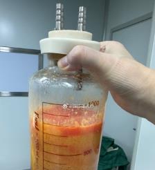 天长水动力吸脂手术要做多久？